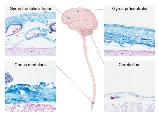 The structure of human leptomeninges 